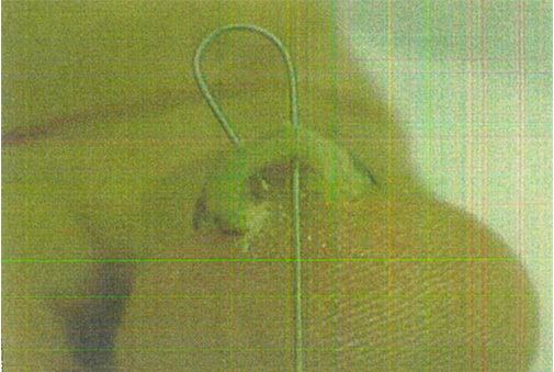 爪矯正具（マチワイヤ：超弾性ワイヤー）による方法
